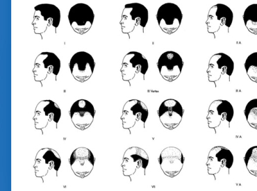 Norwood Scale for Assessing Levels of Hair Loss Baldness in Men