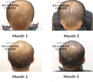 male pattern hair loss the belgravia centre 467136