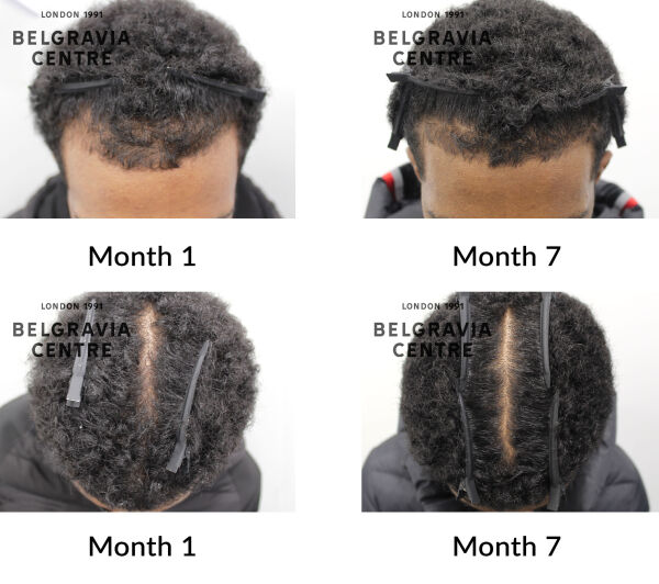 male pattern hair loss the belgravia centre 431225