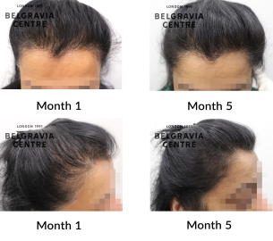 female pattern hair loss the belgravia centre 460298