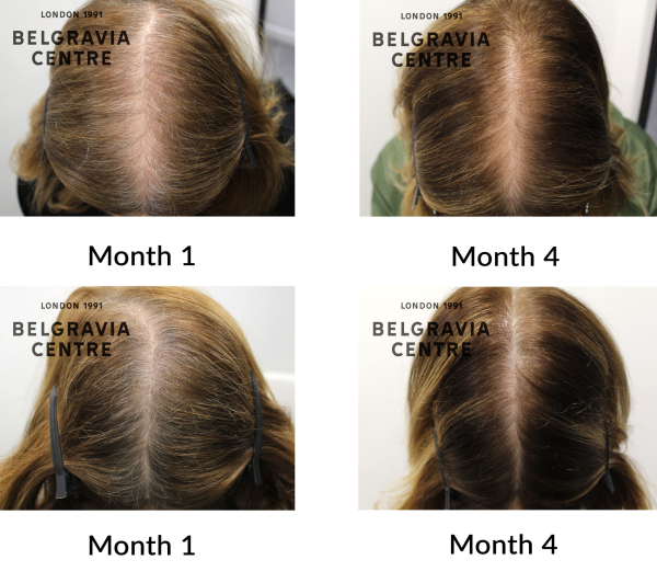 female pattern hair loss the belgravia centre 455012