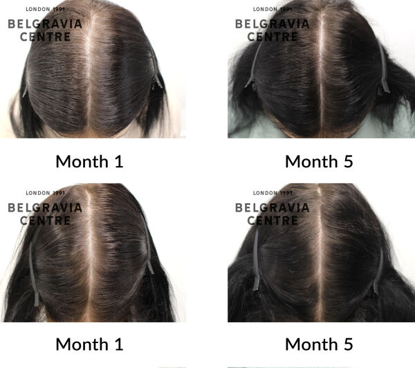female pattern hair loss the belgravia centre 436010