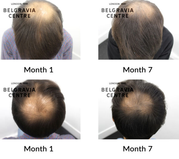 male pattern hair loss the belgravia centre 427111