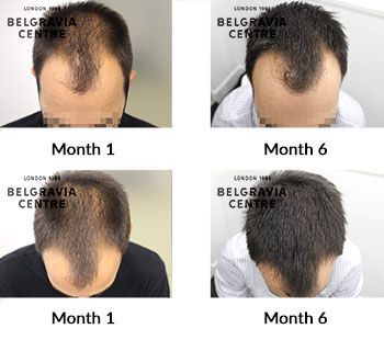 alert male pattern hair loss the belgravia centre 426921