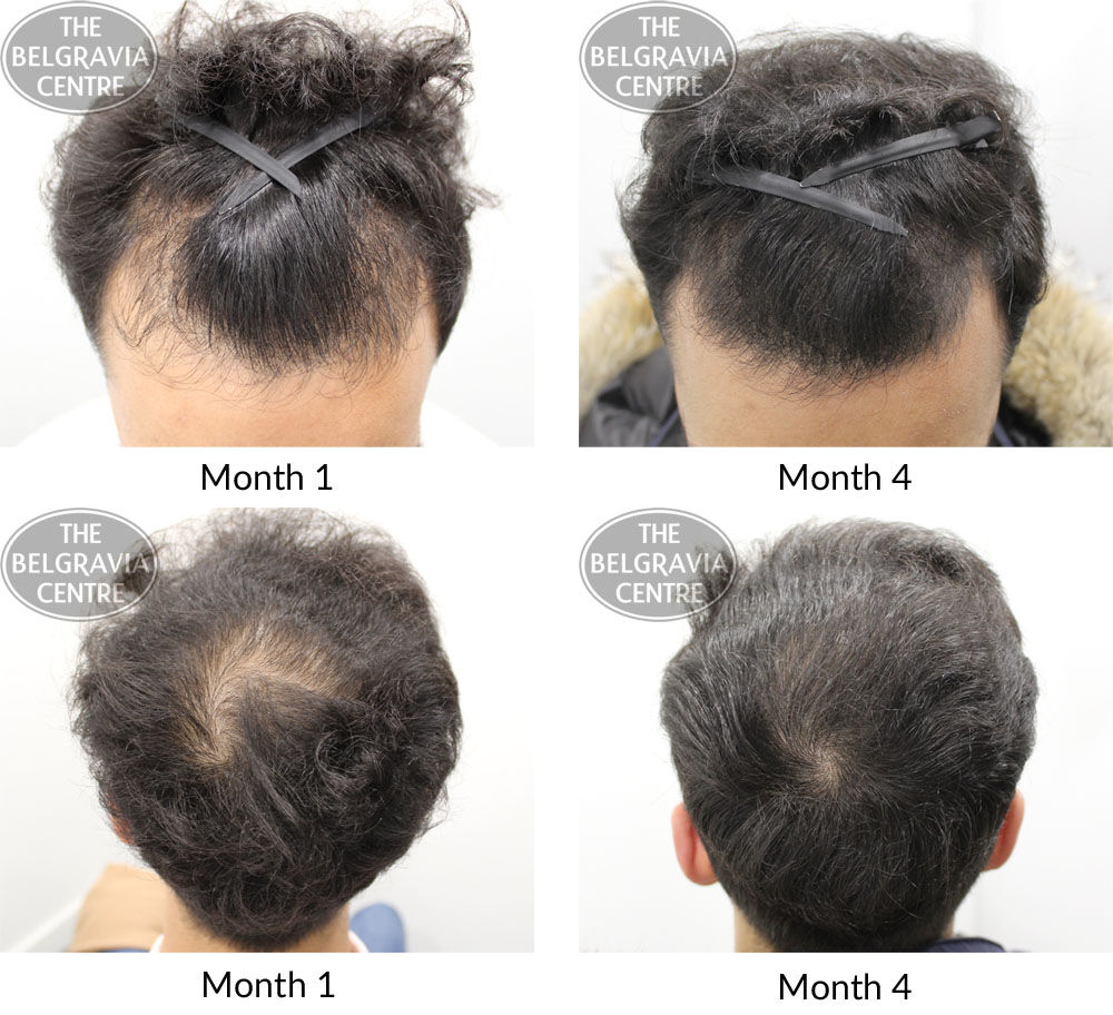male pattern hair loss the belgravia centre SM 17 01 2019