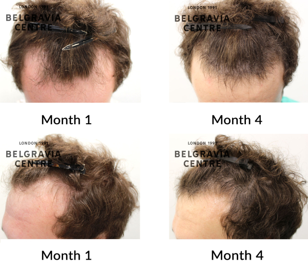 male pattern hair loss the belgravia centre 457779