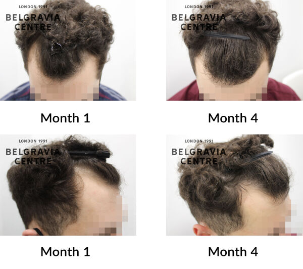 male pattern hair loss the belgravia centre 