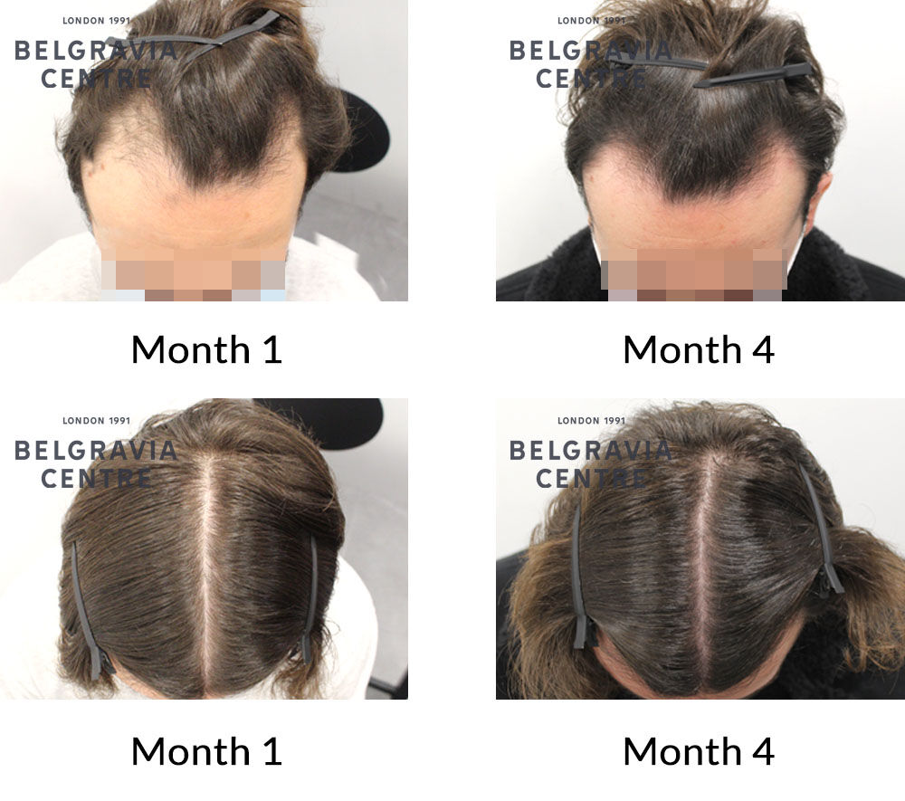 Top 48 image how much does your hair grow in a month 