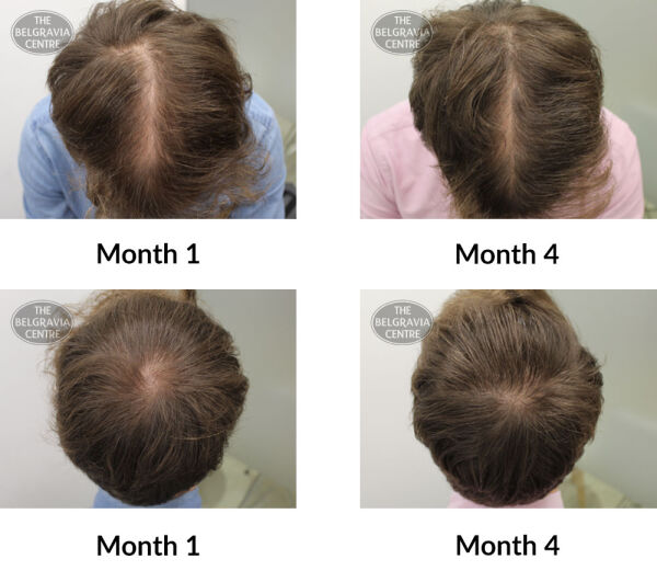 male pattern hair loss the belgravia centre 391740 04 05 2020