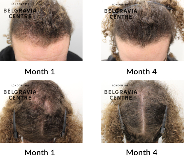 male pattern hair loss the belgravia centre 451308
