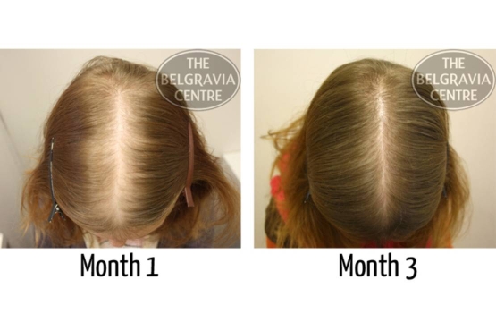 Diffuse Hair Loss Treated at The Belgravia Centre Hair Loss Clinic London