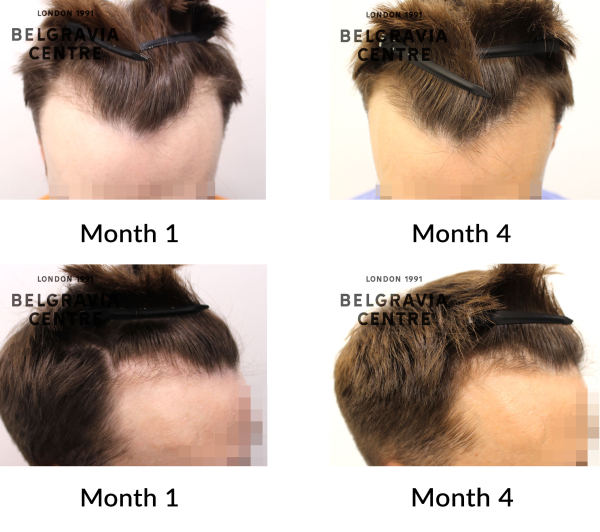 male pattern hair loss the belgravia centre 456872