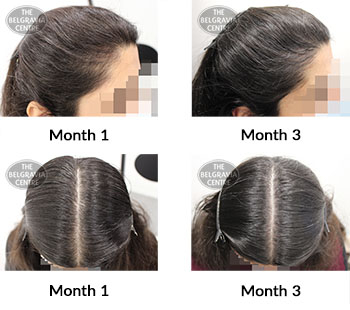 alert female pattern hair loss the belgravia centre 426446 28 10 2021