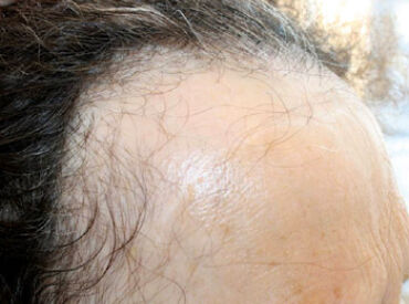 An Example of Frontal Fibrosing Alopecia which Causes a Receding Hairline in Women