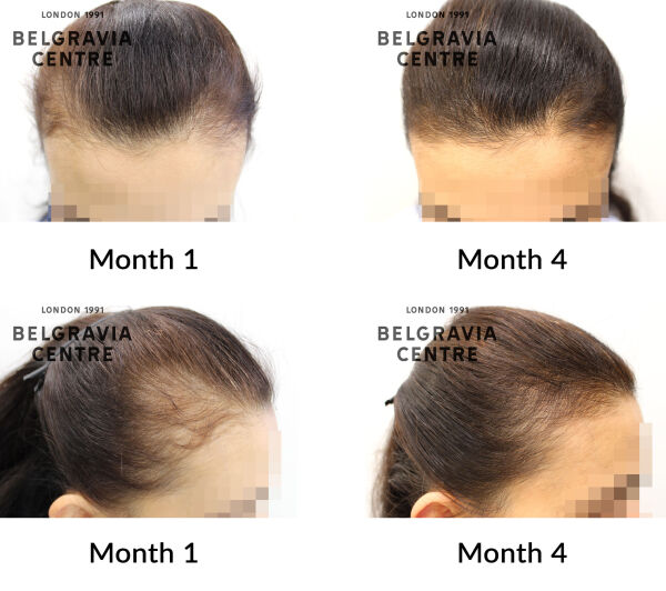female pattern hair loss the belgravia centre 437900