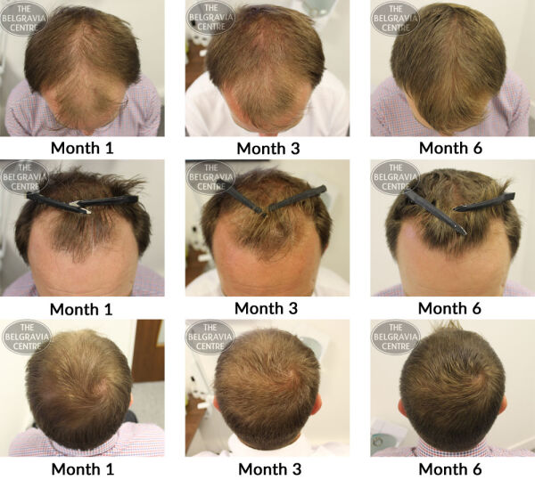 male pattern hair loss the belgravia centre am 24 10