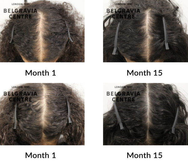 female pattern hair loss the belgravia centre 411285 1024x907