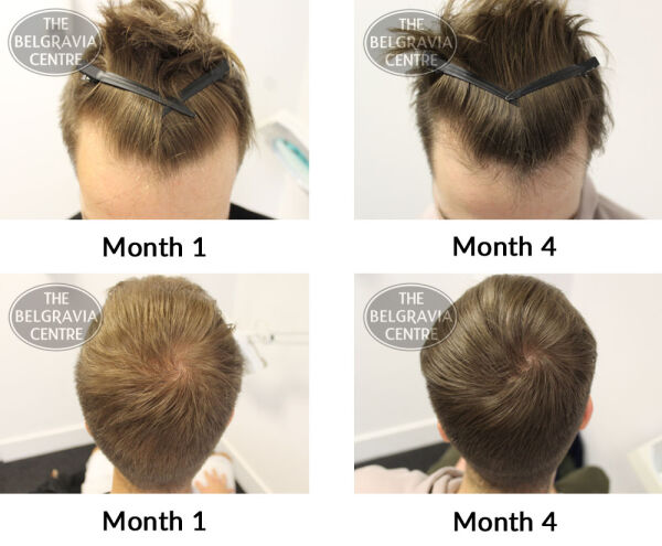 male pattern hair loss the belgravia centre 368958 01 03 2019
