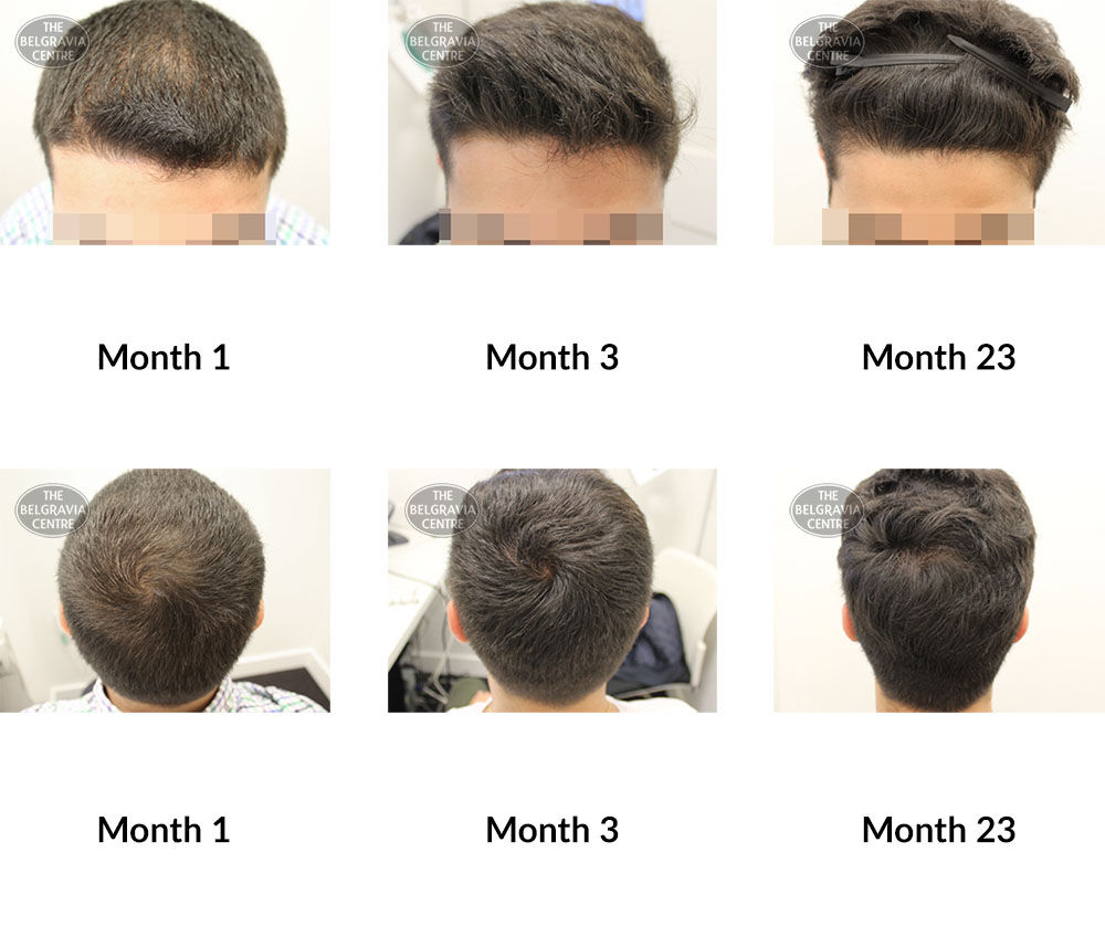 male pattern hair loss the belgravia centre 306910 30 04 2020