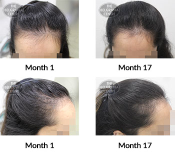 alert female pattern hair loss the belgravia centre 396692 15 07 2021