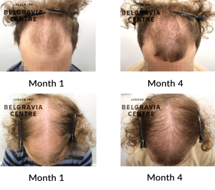male pattern hair loss the belgravia centre 459272