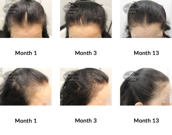 female pattern hair loss and telogen effluvium the belgravia centre 364192 24 06 2019