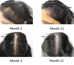 female pattern hair loss the belgravia centre 450173