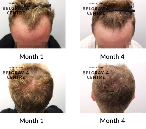 male pattern hair loss the belgravia centre 451497