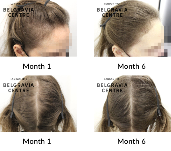 female pattern hair loss and diffuse thinning the belgravia centre 172297