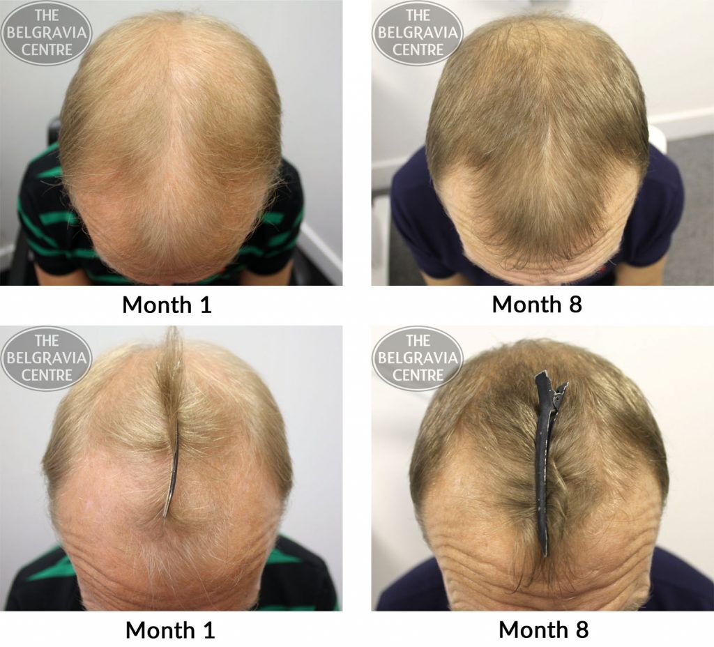 male pattern hair loss the belgravia centre jc 09 01 17 1024x928