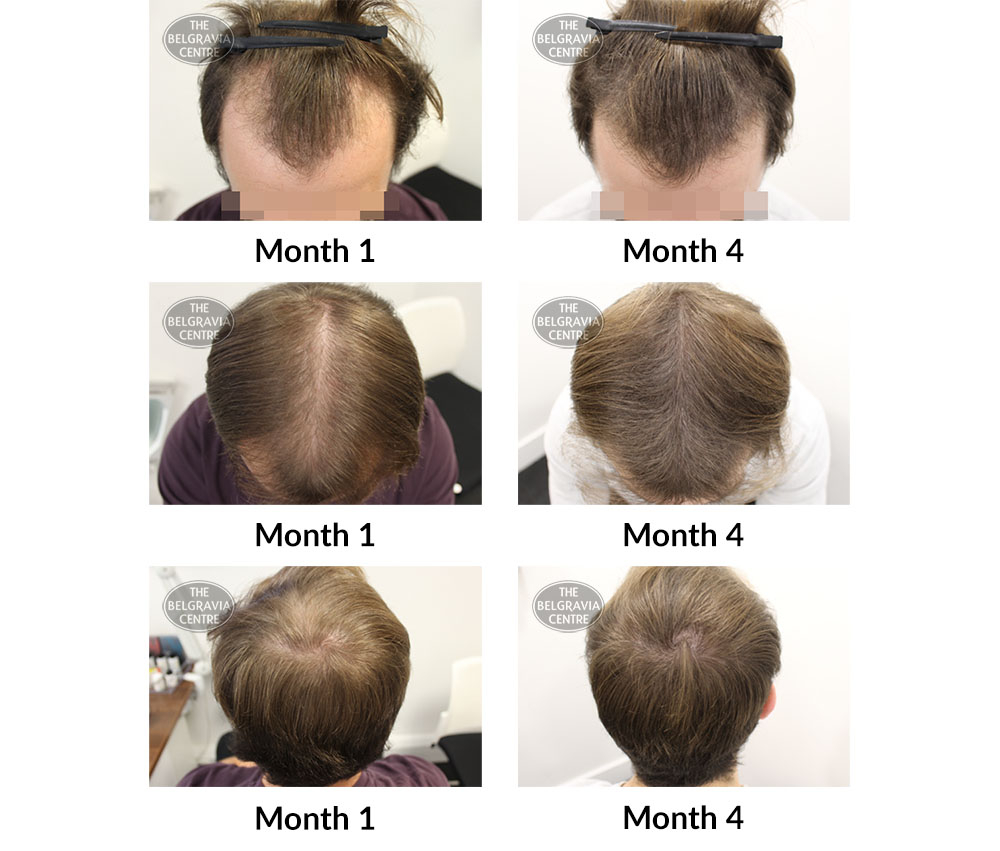 male pattern hair loss the belgravia centre 388506 31 12 2019