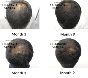 male pattern hair loss the belgravia centre 451315