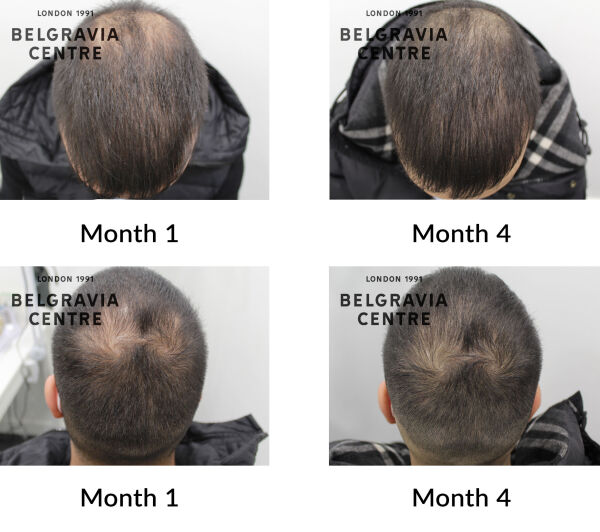 male patterrn hair loss the belgravia centre 431483