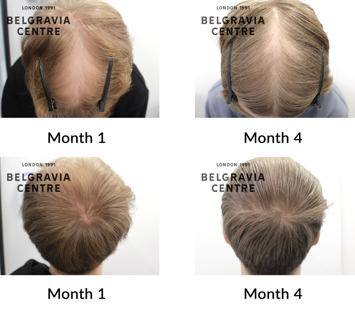 male pattern hair loss the belgravia centre 446753