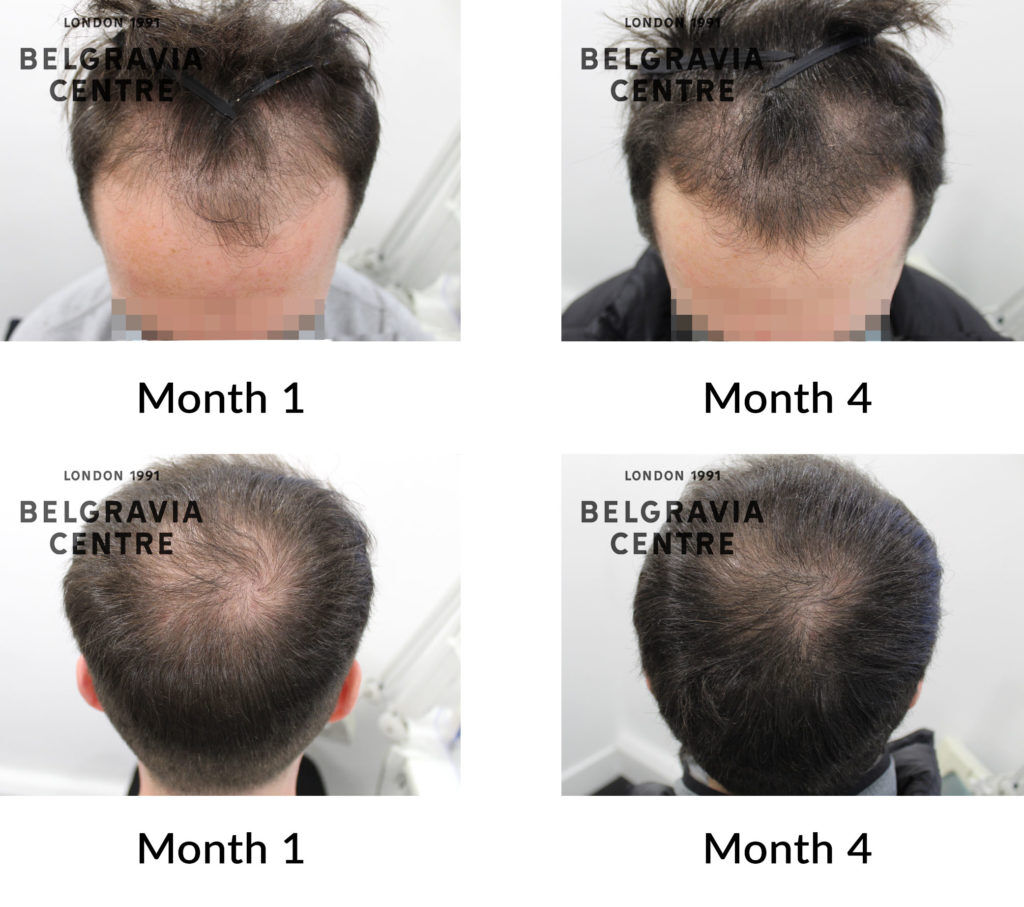 male pattern hair loss the belgravia centre 430518 1024x907