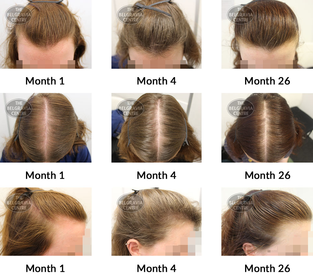 female pattern hair loss the belgravia centre 333806 29 10 2019