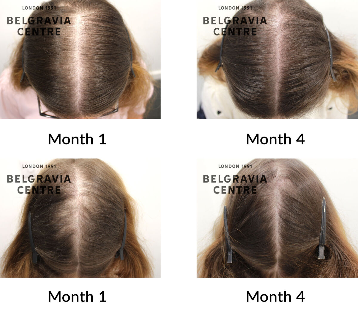 female pattern hair loss and telogen effluvium the belgravia centre 446782
