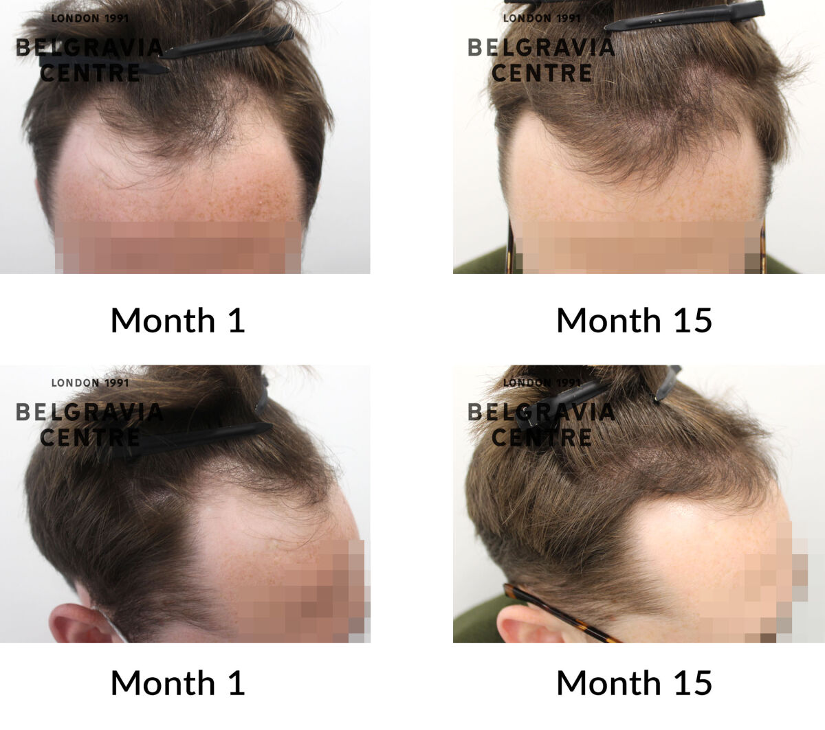 male pattern hair loss the belgravia centre 427813