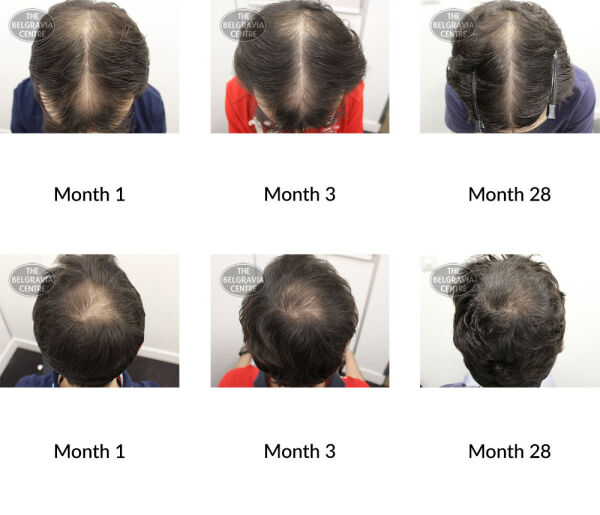 male pattern hair loss the belgravia centre 258507 21 09 20 1