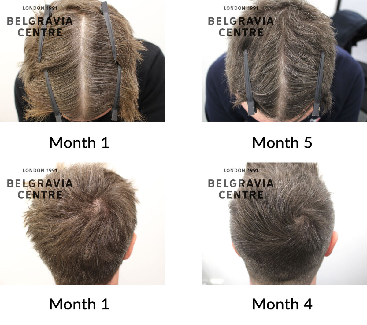 male pattern hair loss the belgravia centre 446013
