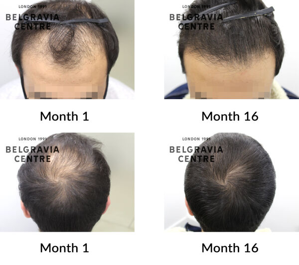 male pattern hair loss the belgravia centre 410753