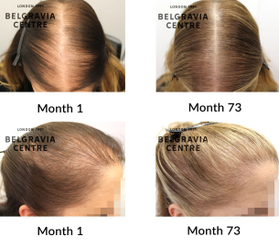 female pattern hair loss the belgravia centre 352979