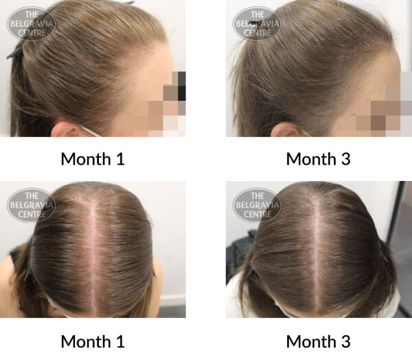 female pattern hair loss and diffuse hair loss the belgravia centre 402863 18 09 2020