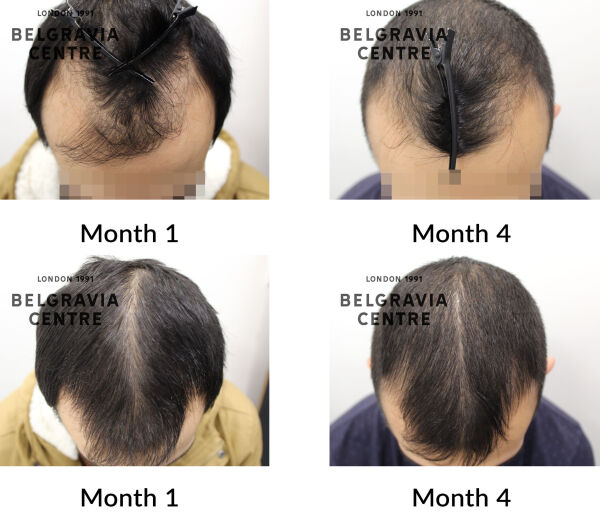 male pattern hair loss the belgravia centre 436863