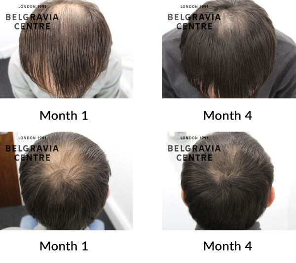 male pattern hair loss the belgravia centre 432769