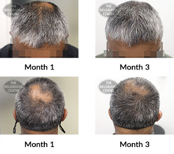 alert male pattern hair loss the belgravia centre 425249 20 10 2021
