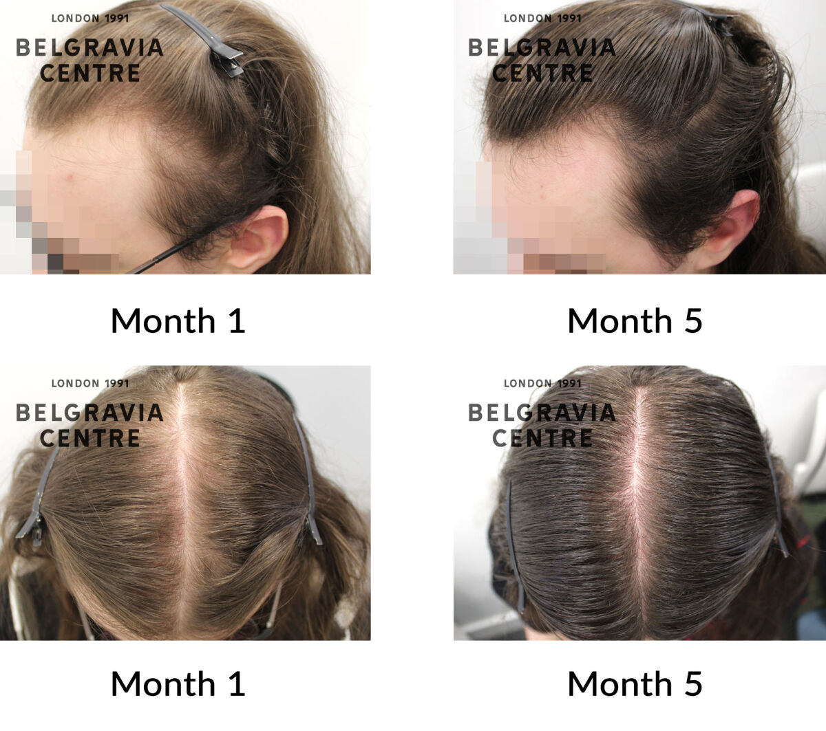 male pattern hair loss the belgravia centre 446219