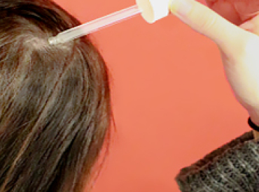 Womens Hair Loss Treatment Applying Minoxidil