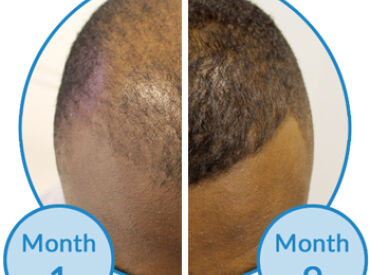 Success Story Male Pattern Hair Loss Treatment The Belgravia Centre