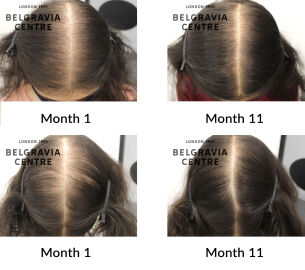 female pattern hair loss and diffuse thinning the belgravia centre 430113